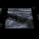 Acute enteritis, enteritis, edema of the valvulae conniventes: US - Ultrasound